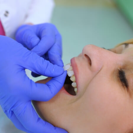 Smile compared with shade option before dental bonding