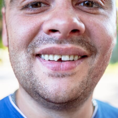 Smile with chipped front tooth before dental bonding treatment
