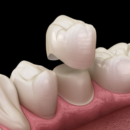 Animated smile during dental crown placement