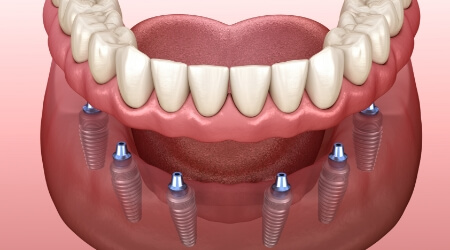 Animated smile during dental implant denture palcement