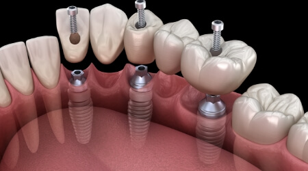 Animated smile during dental implant supported fixed bridge placement