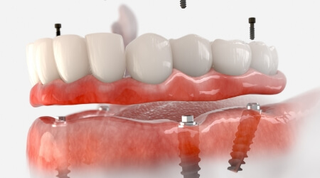 Animated smile during dental implant supported denture placement