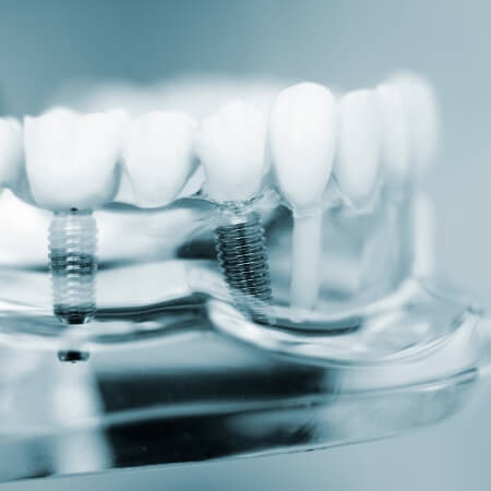 Closeup of model smile with dental implant supported fixed bridge