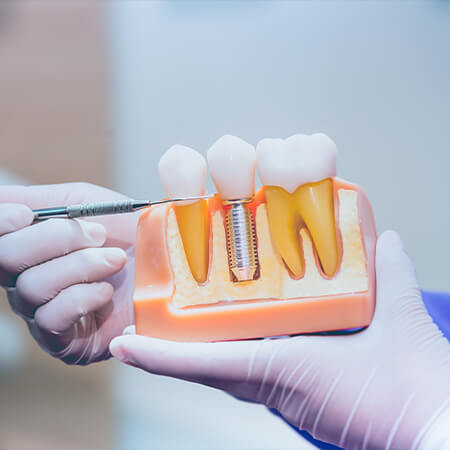 Model smile with dental implant supported dental crown restoration
