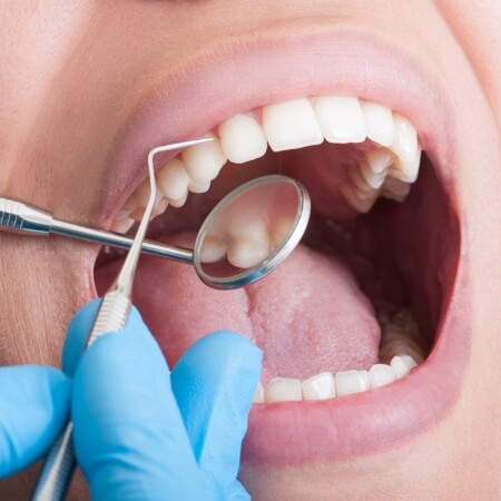 Closeup of smile during oral cancer screening