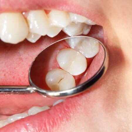 Dentist examining smile with dental sealants