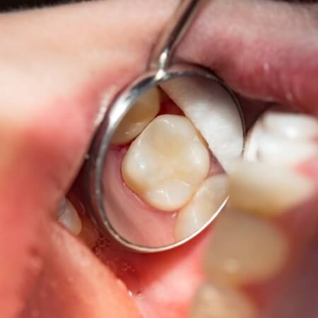 Closeup of smile repaired with tooth colored filling