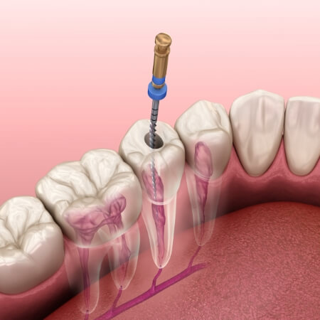 Animated smile during root canal treatment