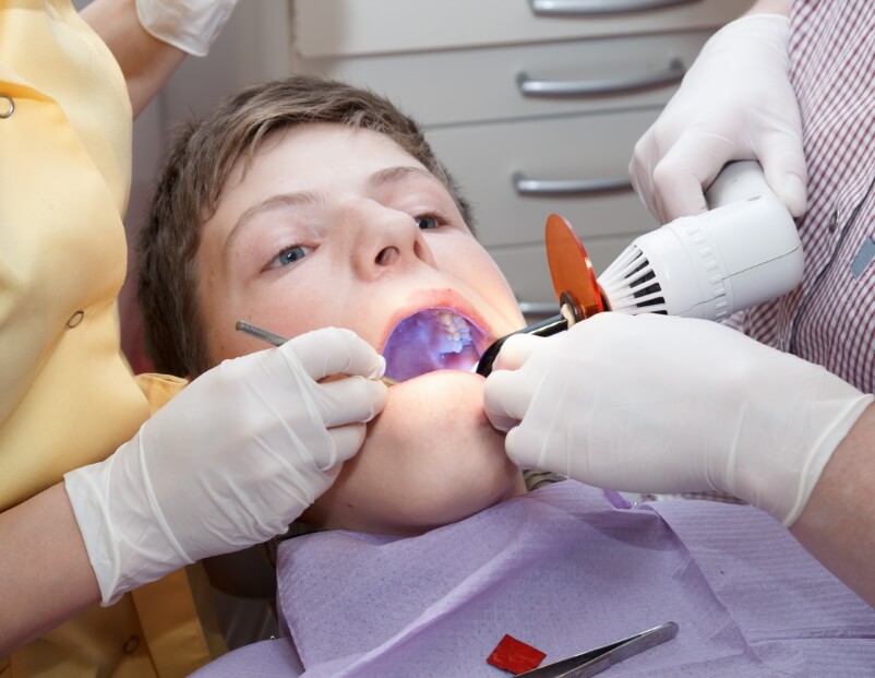 Dentist applying dental sealants