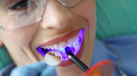 Dental patient receiving dental sealants during a routine dental checkup